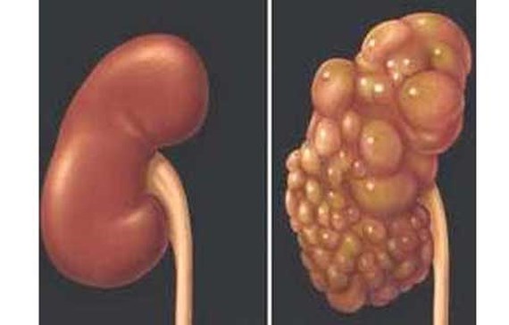 Nang đơn thận - Hình ảnh minh họa